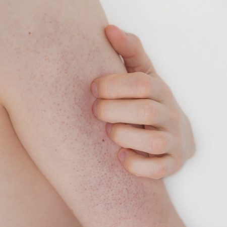 Rogowacenie skóry – przyczyny, objawy pielęgnacja